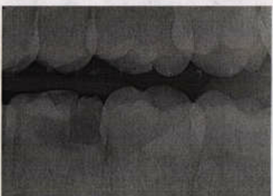 Non-qualifying: X-ray is non-diagnostic as interproximal contacts are overlapped and fail to show bone loss