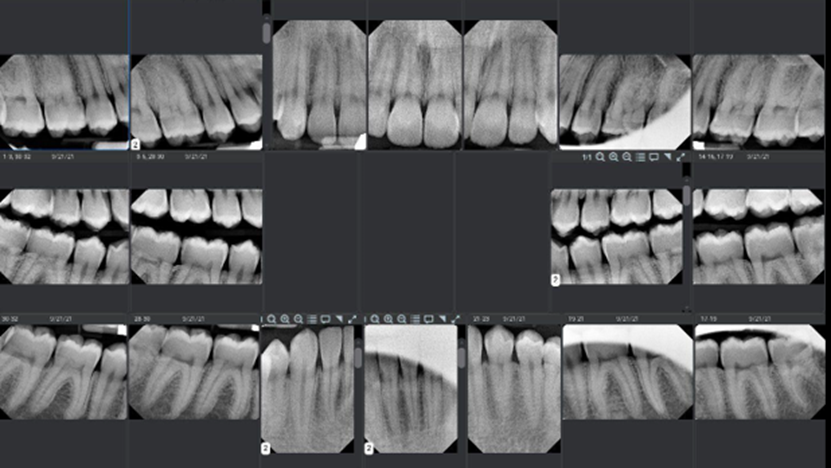 Non-qualifying: X-rays show no appreciable bone loss and calculus 