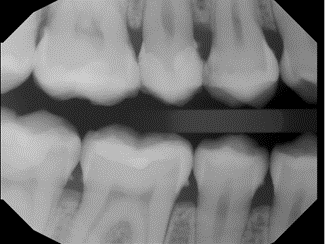 Qualifying: X-rays clearly shows appreciable bone loss and calculus