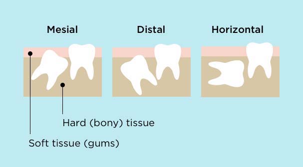 Mesial impaction is when the tooth comes in angled towards other teeth, while distal means angled away from other teeth. Horizontal impaction is when teeth grow in sideways. Teeth can be impacted in hard (bony) tissue or soft tissue (gums).
